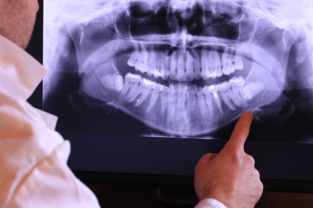 Best Emergency Dentist for Lost Fillings or Crowns in Clarkesville, GA