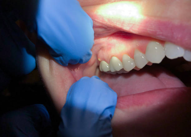 Best Emergency Dentist for Knocked-Out Tooth in Clarkesville, GA